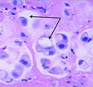 Перстневидноклеточный рак низкодифференцированная аденокарцинома желудка