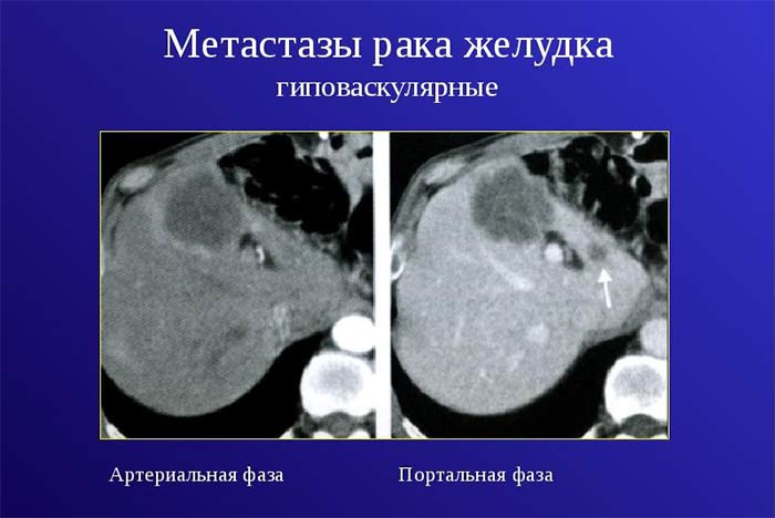 Рак желудка метастазы в печени и поджелудочной железе