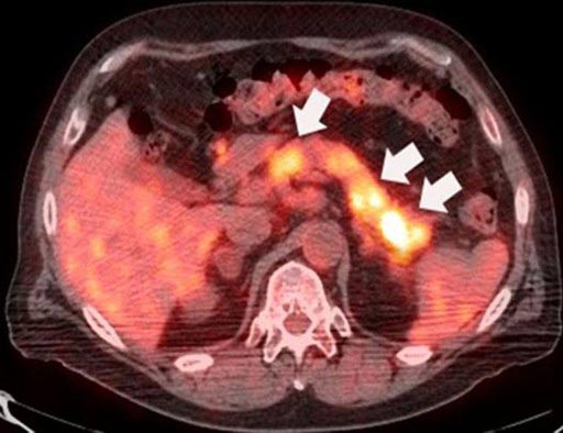 Рак поджелудочной железы 4 стадии сколько живут thumbnail