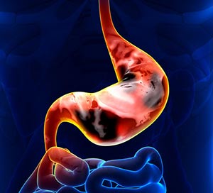 Рак желудка метастазы в печени и поджелудочной железе