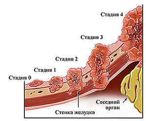 Рак желудка 4 стадии легких