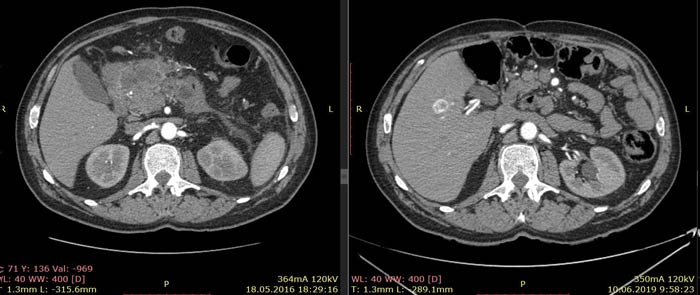 Рак желудка с инвазией в поджелудочную железу thumbnail